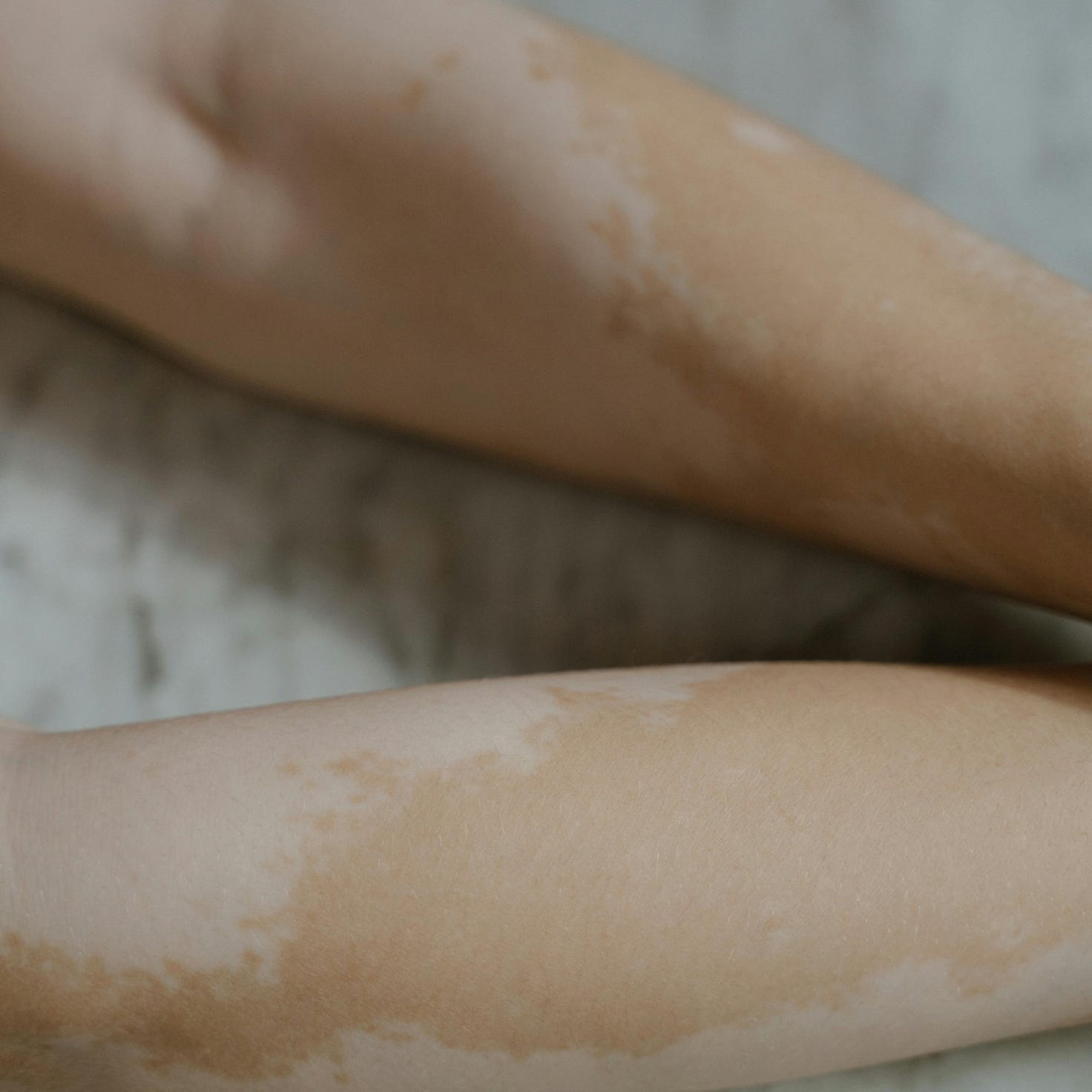 Detailed image of legs with vitiligo, emphasizing self-love and uniqueness.